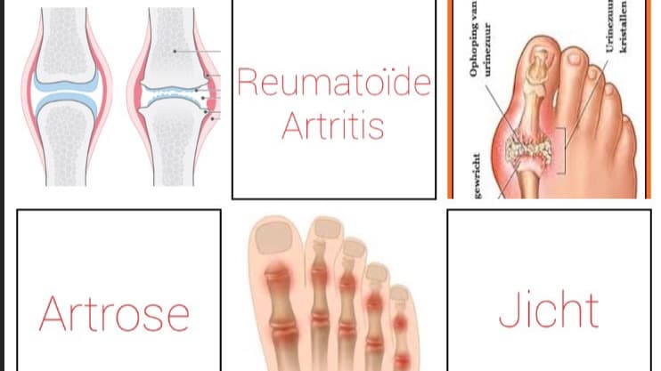 soorten reuma